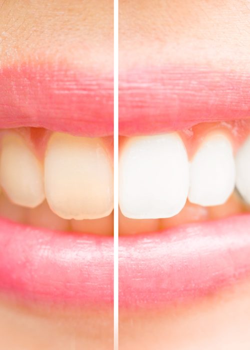 Close-up teeth female between before and after brush the teeth.